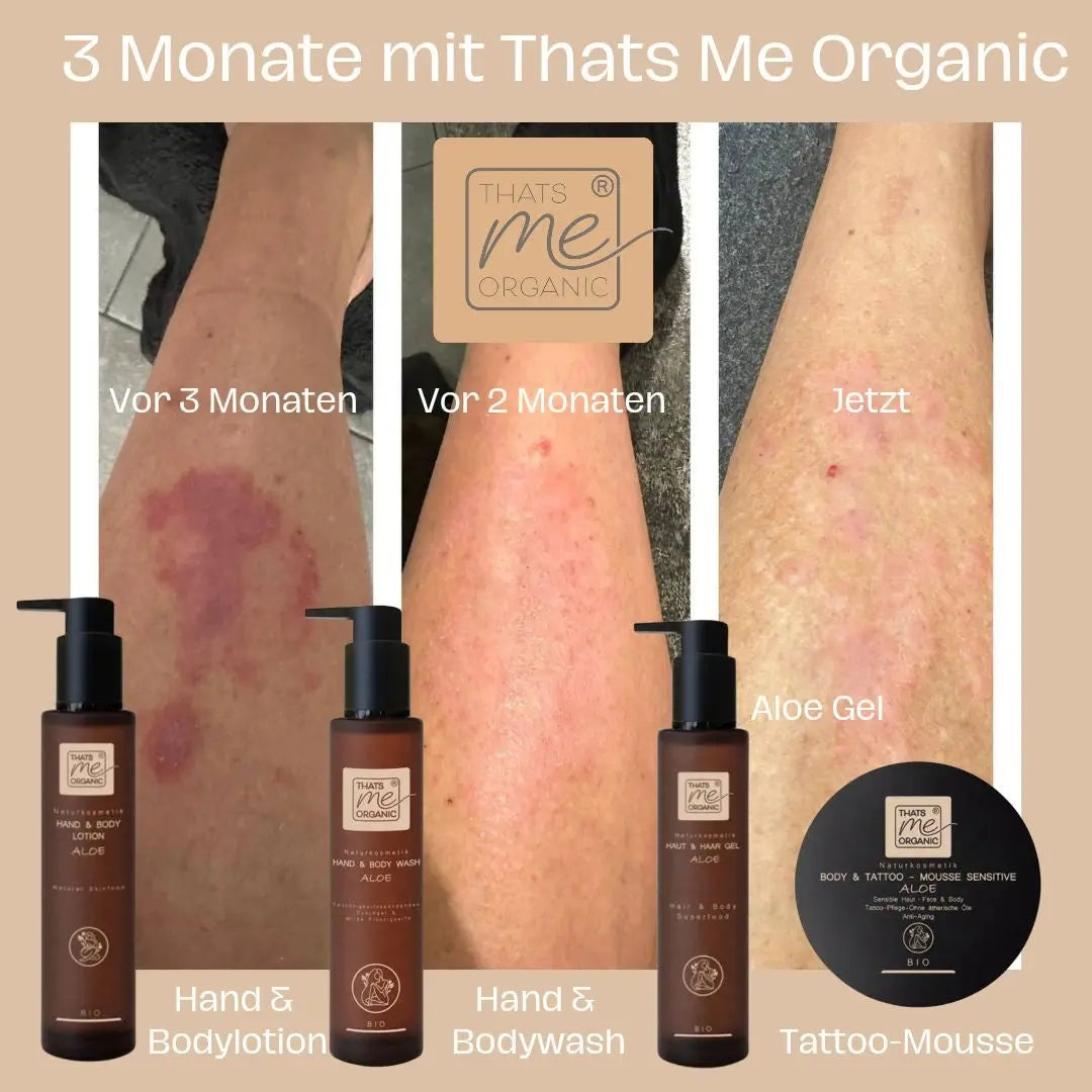 Sichtbare Hautverbesserung an drei Beinen innerhalb von 3 Monaten unter Verwendung der Thats me organic® Bio Hand & Body Lotion mit Aloe; Naturkosmetik-Flaschen siehe unten.