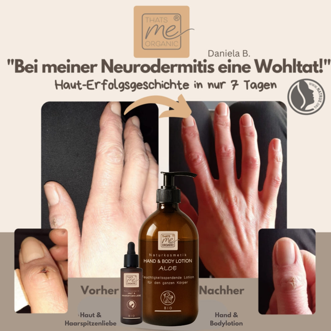 Handpflege-Werbung: Sichtbare Verbesserung bei Neurodermitis - Hände vor und nach Anwendung mit Thats me organic® Bio Hand & Body Lotion auf Aloe-Basis. Naturkosmetik-Flasche im Fokus.
